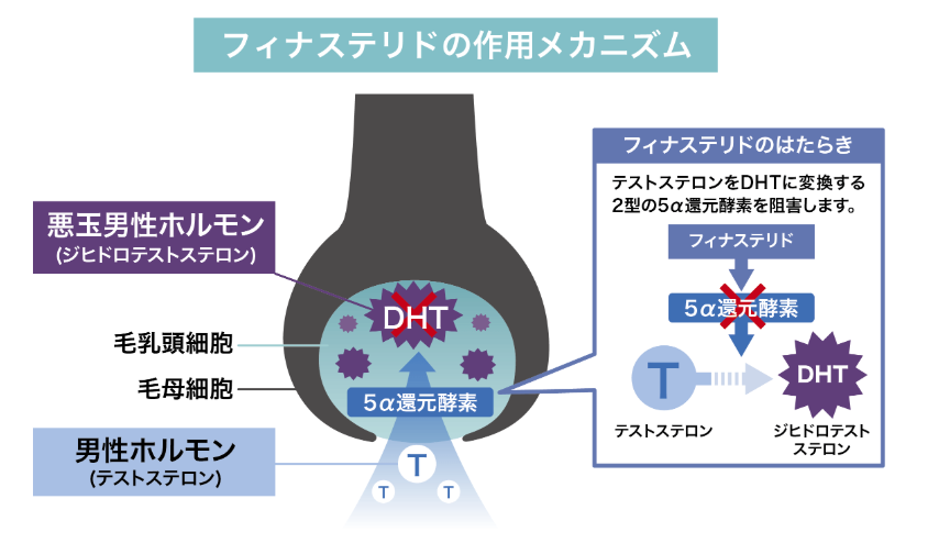 DMMオンラインクリニック　AGA　フィナステリド