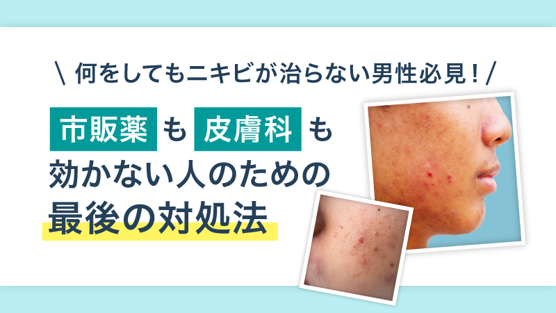 何をしてもニキビが治らない男性必見!市販薬も皮膚科も効かない人のための最後の対処法