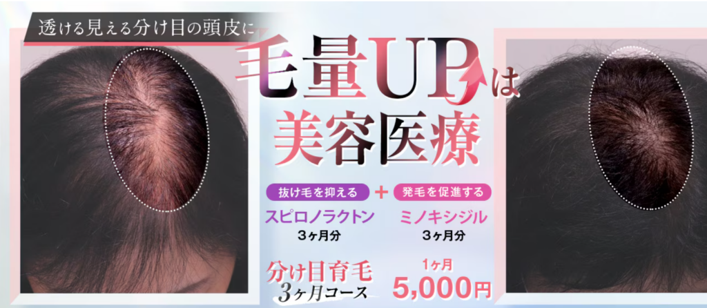 湘南美容クリニックの女性薄毛治療